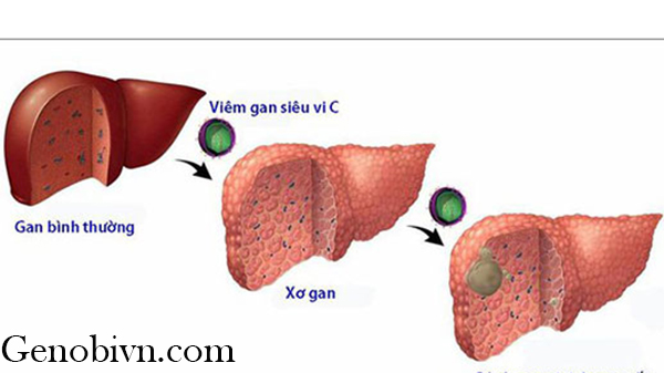 Viem Gan C